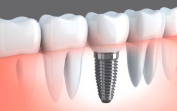 Razones por las que debemos optar por un implante dental